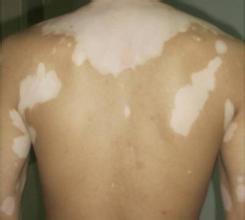 哪些食物对白癜风治疗有作用 哪些食物对白癜风治疗有作用.jpg