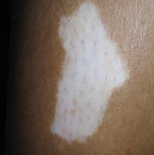 白癜风病情稳定可以要孩子吗 白癜风病情稳定可以要孩子吗.jpg