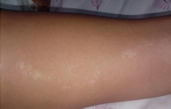 白癜风患者需要避免淋雨么 白癜风患者需要避免淋雨么.jpg